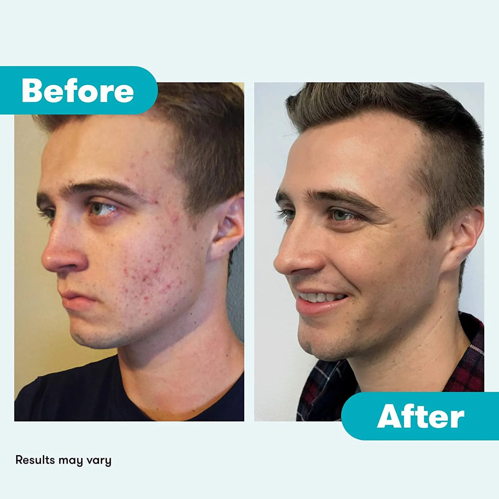 Acne System with Purifying Mask P935